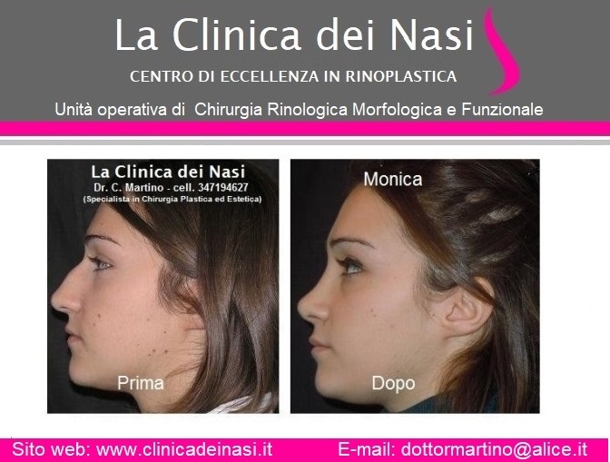 open nose surgery open nose surgery