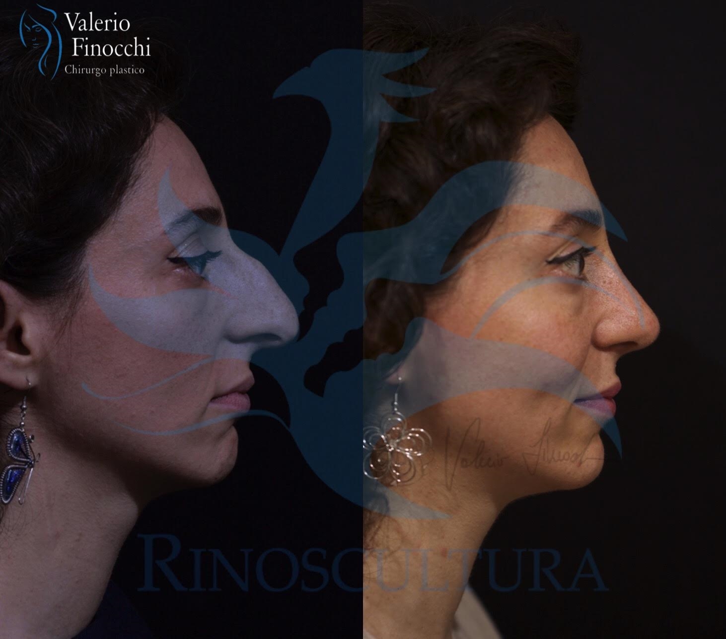 open nose surgery open nose surgery